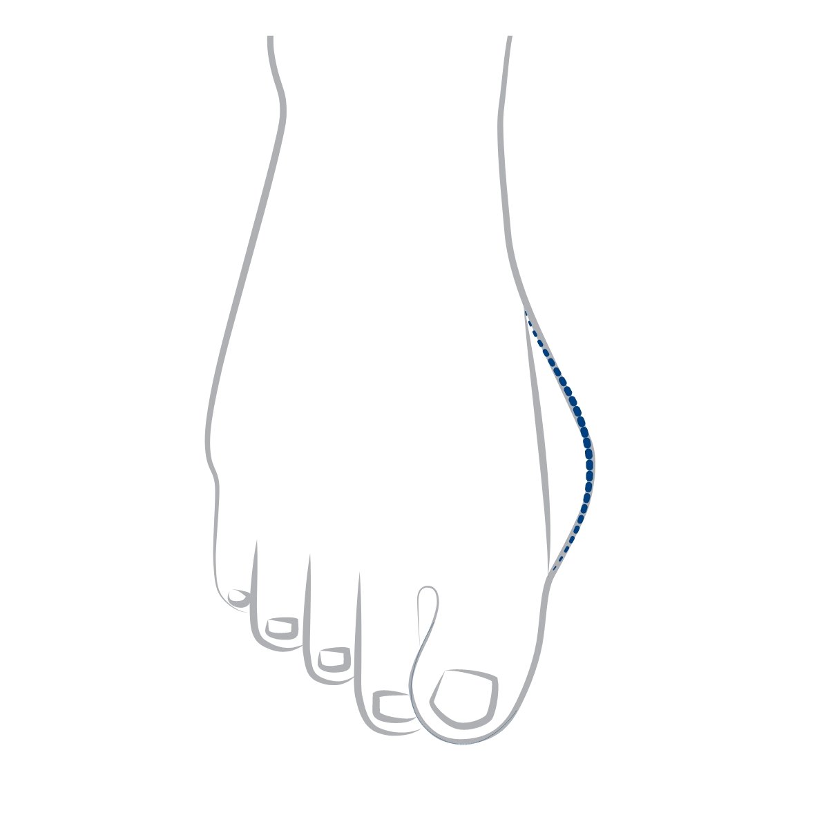 Grafik eines Fußes mit Hallux Valgus